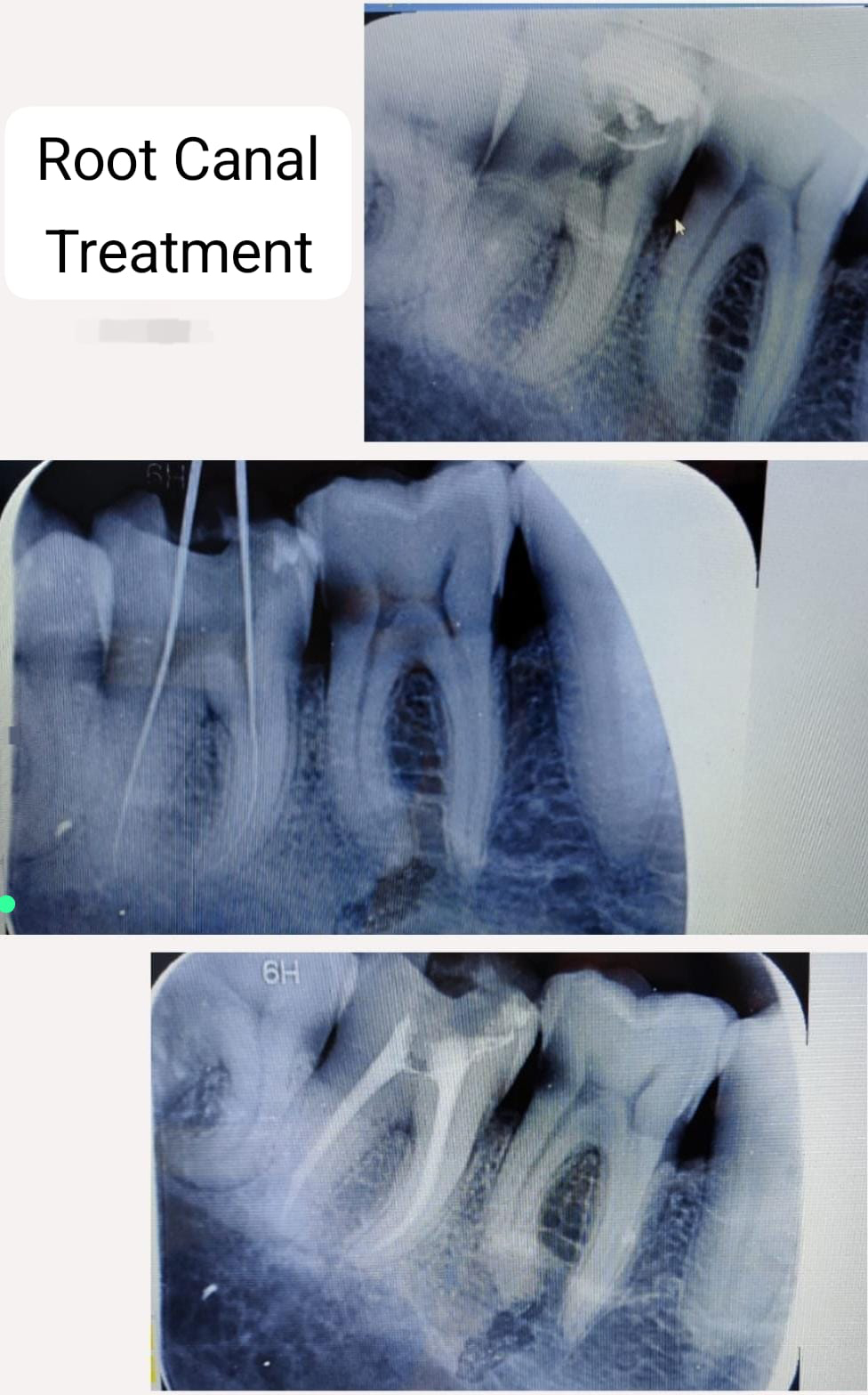 Root Canal Treatment